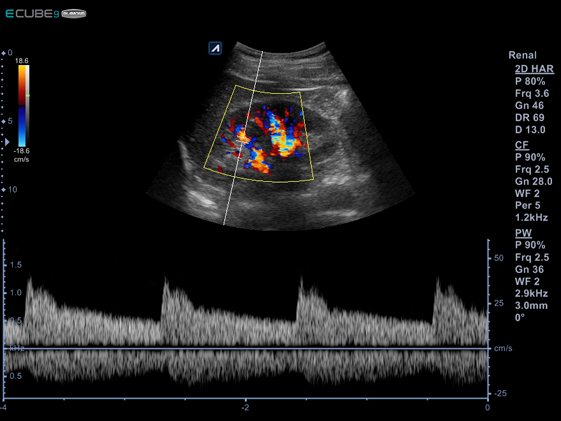 5_Renal_artery_normal_spectral_trace3.jpg